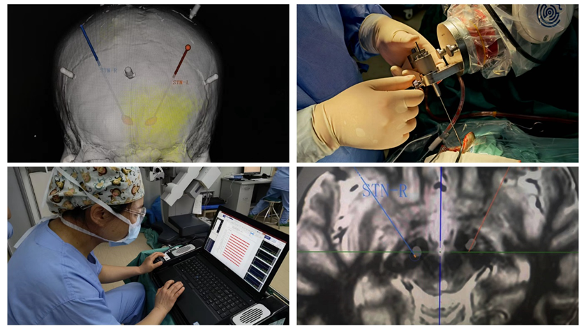 探索创新术式，盈康生命搭建脑机接口治疗帕金森全流程方案