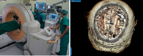 探索创新术式，盈康生命搭建脑机接口治疗帕金森全流程方案