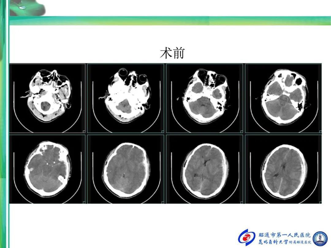 超研股份：超声在颅脑应用已获多项专利